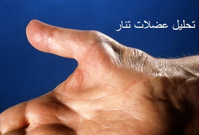 تحلیل عضلات تنار