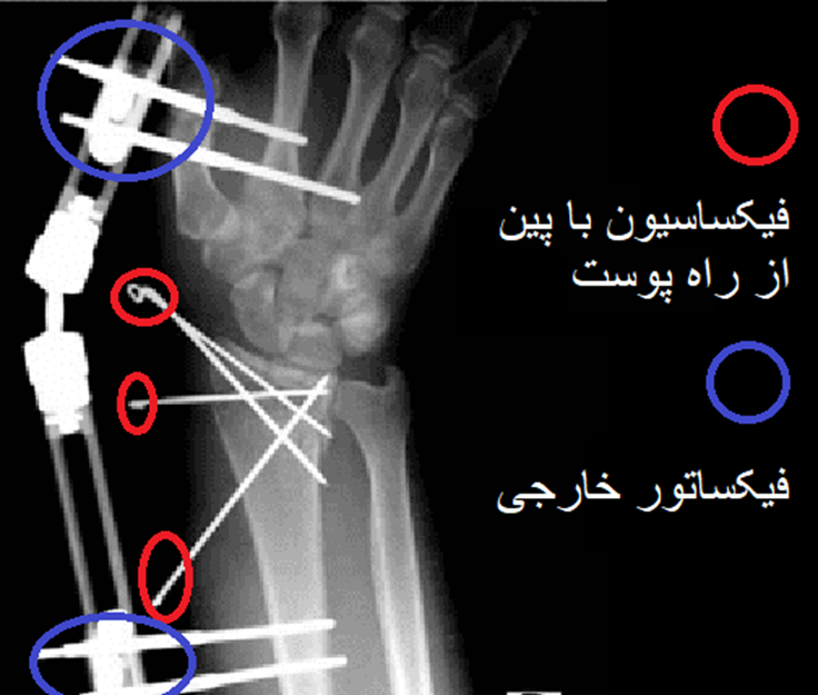 فیکساسیون خارجی و فیکساسیون با پین 