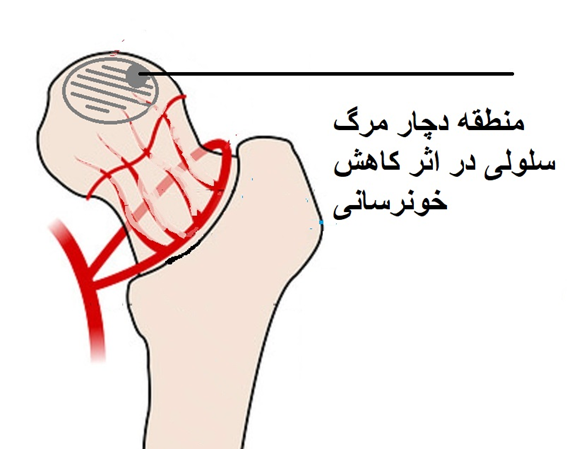 نکروز سر در اثر کمبوذ خونرسانی