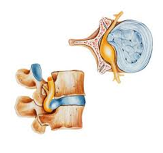فتق دیسک بین مهره ای و فشار به ریشه عصبی