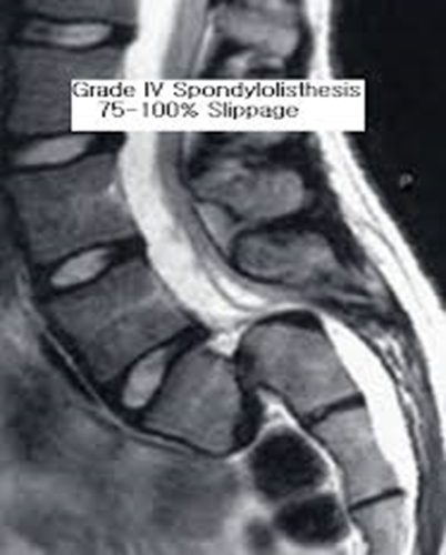 لغزندگی کامل مهره 5 کمری