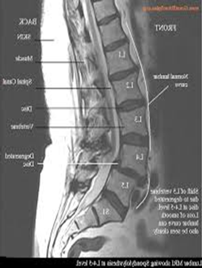 لغزندگی مهره 4 کمر در آرتروز