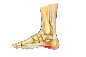 التهاب نیام/فاشیای کف پا (plantar fasciitis)