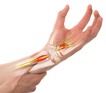 سندروم کارپال تونل  CTS چیست ؛ چه علائمی دارد و چطور باید درمان شود؟