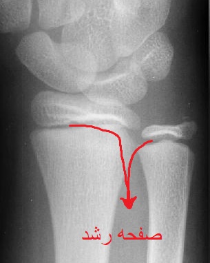شکستگی دیستال رادیوس ( مچ دست ) در اطفال ( زیر 13 سال )
